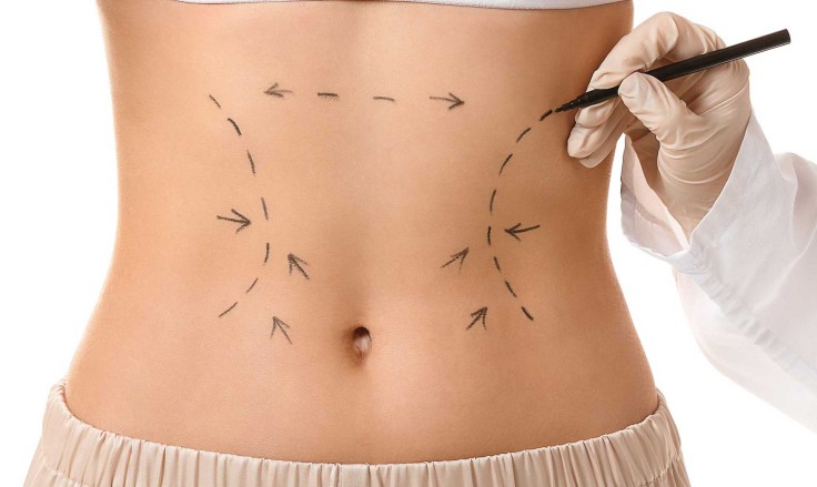 How Much Fat Can Be Removed with Liposuction?