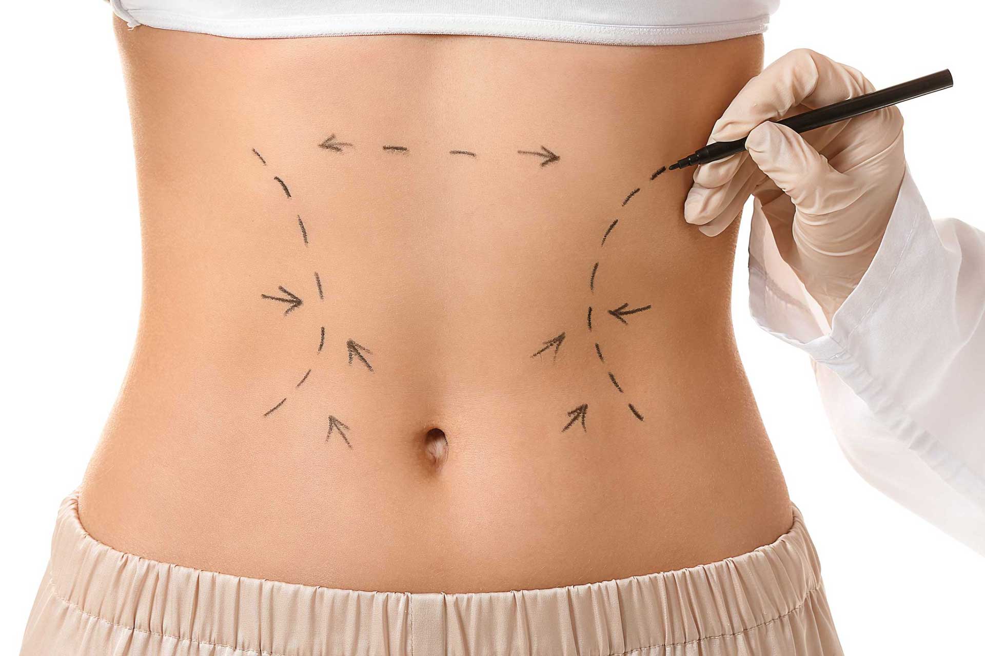 What Should You Ask a Plastic Surgeon Before Having a Liposuction?