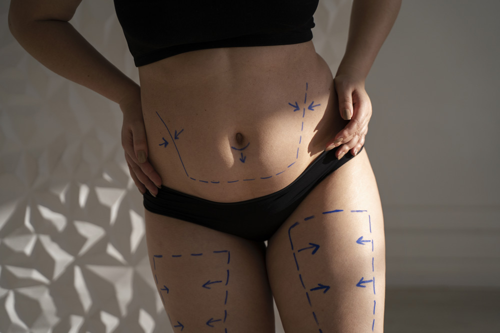 Tummy Tuck vs. Liposuction: Can You Combine Both for Better Results?