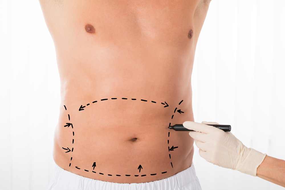 How Long Do Liposuction Results Last?