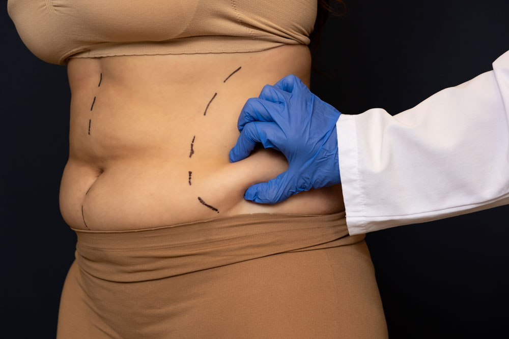 Mommy Makeover or Tummy Tuck: What's Your Choice