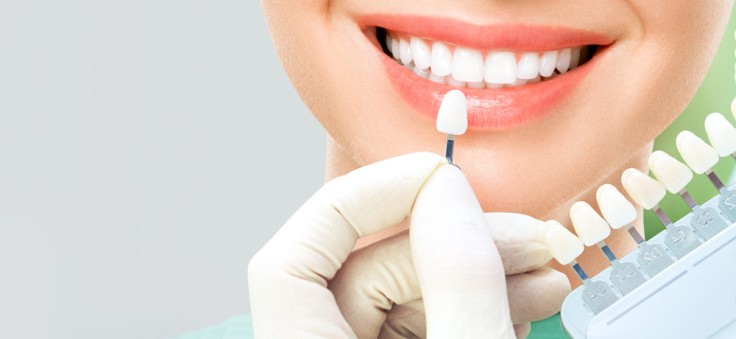 8 curiosidades sobre los veneers dentales