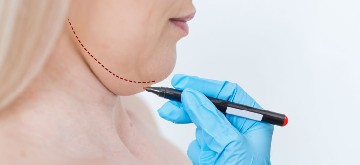 Neck Liposuction Vs. Neck Lift: What's The Difference?