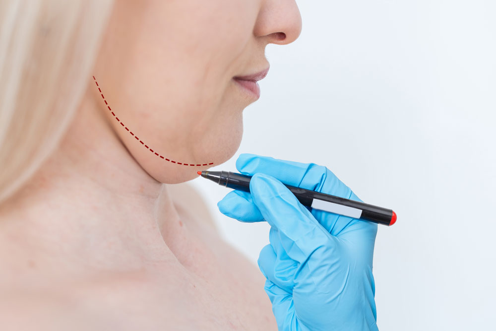 Neck Lift in Turkey: What to Expect, Procedure, Cost