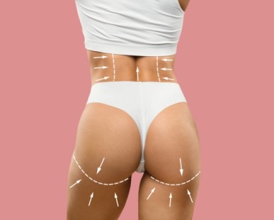 Thigh Liposuction in Turkey: What To Expect, Procedure, Cost