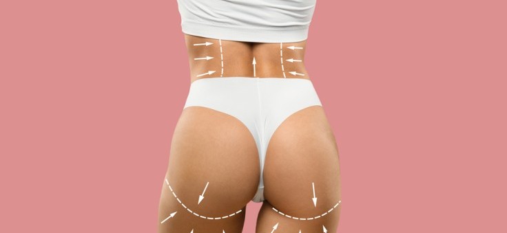 Thigh Liposuction in Turkey: What To Expect, Procedure, Cost