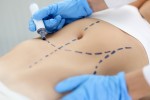 Cómo prepararse para una cirugía estética de abdominoplastia