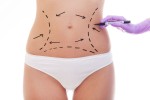 5 Tips for Reducing Swelling After a Tummy Tuck