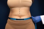 Healthy Diet After Tummy Tuck