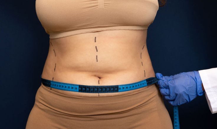 How Soon Can You Exercise After a Tummy Tuck?