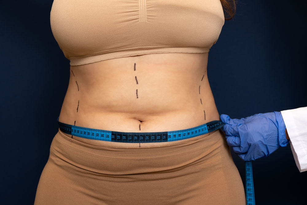 5 Common Concerns About Tummy Tuck (Abdominoplasty)