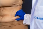 Tummy Tuck Surgery Procedure Steps in Turkey