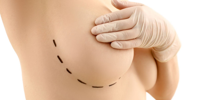 Types of Breast Implants: A Comprehensive Guide to Breast Augmentation